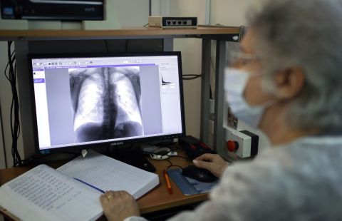 Главный фтизиатр Москвы назвала необычные симптомы туберкулеза